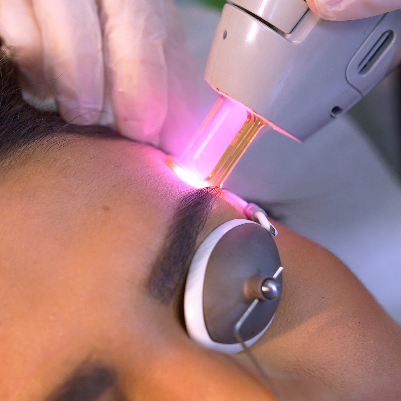 Laser Hair Removal above Eyebrows in Dubai