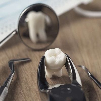 Things You Must Know Before Tooth Extraction in Dubai