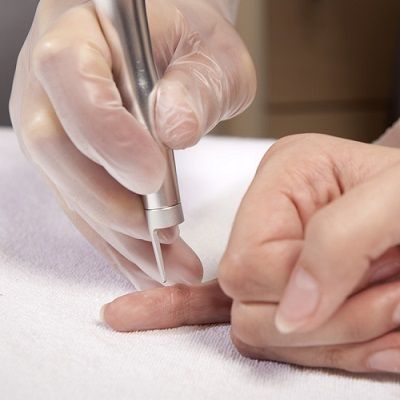 What to Do After Removal Of Warts