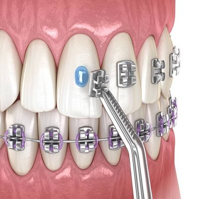 Which Type Of Braces Are The Best In Dubai