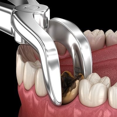 Wisdom Tooth Extraction Cost in Dubai