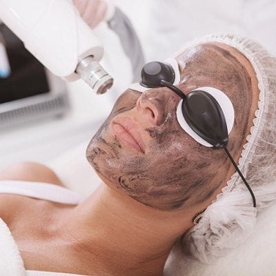 Carbon Laser Peel for Melasma