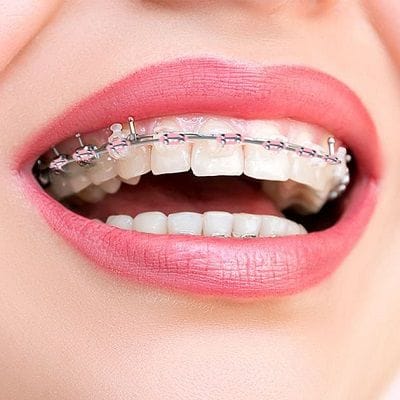 Dentofacial Orthopedics in Dubai