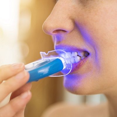 ¿Es el blanqueamiento dental con láser una opción segura?
