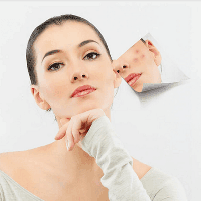 Acne Scar Removal Treatment in Dubai