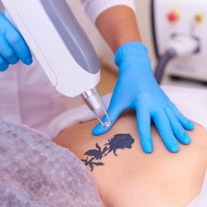 Laser Tattoo Removal in Dubai