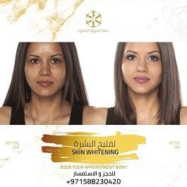 Skin Whitening Dubai