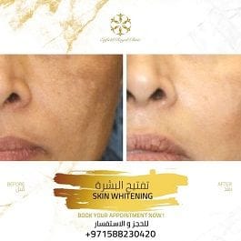 Skin Whitening Treatment in Dubai