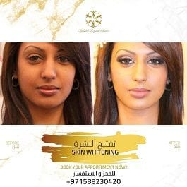 Skin Whitening in Dubai
