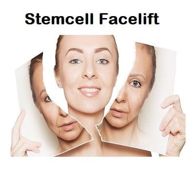 Stemcell Facelift Cost in Dubai