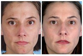 microdermabrasion facial price