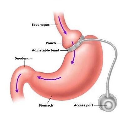 Everything About Gastric Band Surgery in Dubai
