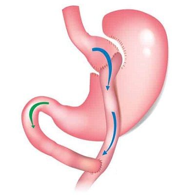 Gastric Bypass Surgery Cost in Dubai