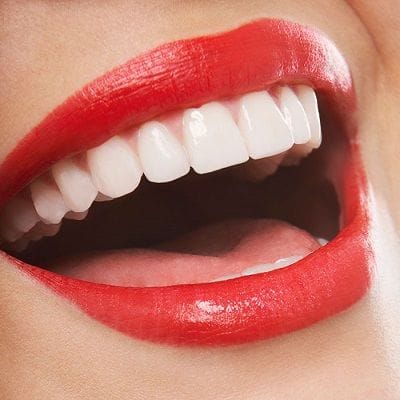 Hollywood Smile Design Cost in Dubai smile design