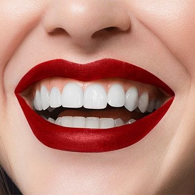 Hollywood Smile Design in Dubai