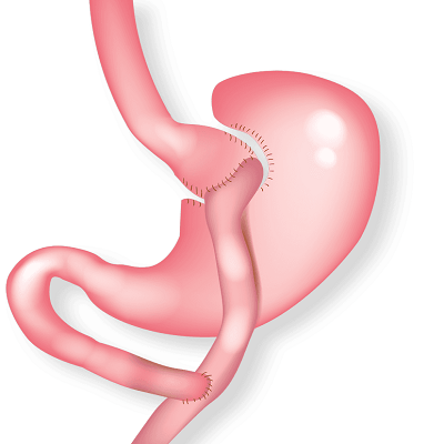 Mini Gastric Bypass Overview
