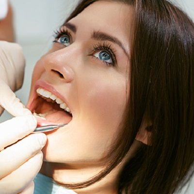 What is the Cost Of an Esthetic Bridge in Dubai?