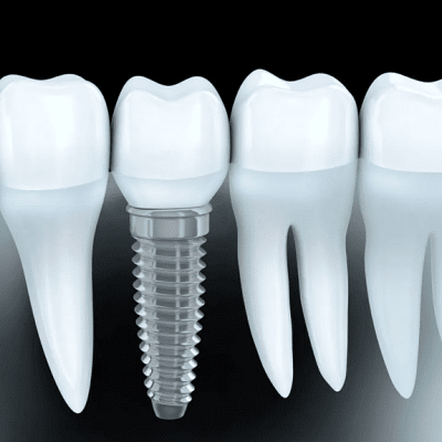 What is the Cost of a Zirconia Implant in Dubai Zirconia Implant