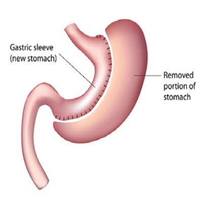 Gastric Sleeve Surgery Cost in Dubai