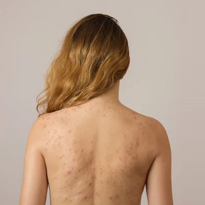 Back Acne Treatment in Dubai - How to See Clearer Skin -Back Acne Solutions