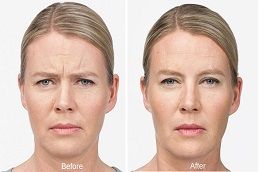 Botox injection treatment Dubai