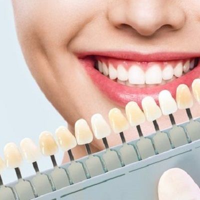 Composite Veneers Cost In Dubai Composite Veneers