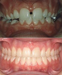 Dentofacial orthodontic Treatment