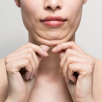 Double Chin Surgery What to Expect, Cost and Recovery | Dynamiclinic Dubai