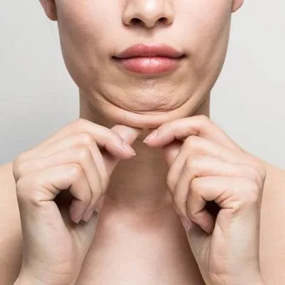 Double Chin Surgery: What to Expect Cost and Recovery