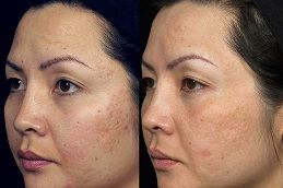 Fractional Laser and PRP Therapy