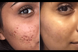 Freckles and Blemishes Treatment Clinic Dubai