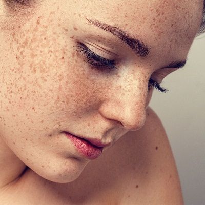 Freckles and Blemishes Treatment in Dubai, Abu Dhabi & Sharjah