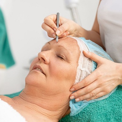 Get Rid of Wrinkles Around the Eyes Brow LIft Surgery - Dynamic Clinic