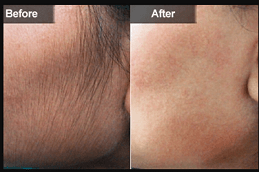 Laser Hair Bleaching Clinic Dubai
