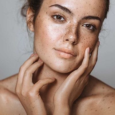 Melasma Treatment in Dubai
