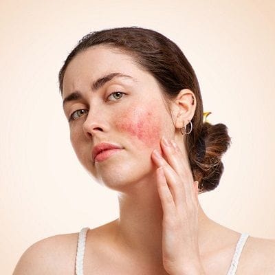 Rosacea Treatment in Dubai, Abu Dhabi & Sharjah