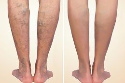 Treatment of varicose before and after. Varicose veins on the legs.