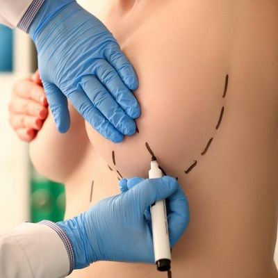 Best Plastic Surgeon in Dubai for Breast Augmentation