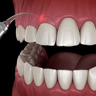 Gingivectomy surgery cost in Dubai