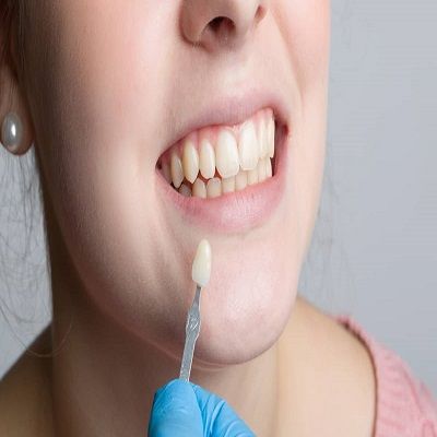 Protruded teeth treatment cost in Dubai