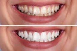 Best Zoom Teeth Whitening in Dubai