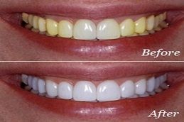 Teeth Whitening Strips in Dubai