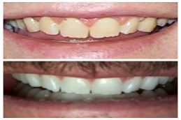 Teeth Whitening Strips Dubai