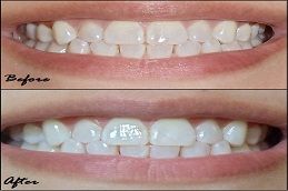 Best Teeth Whitening Strips in Dubai