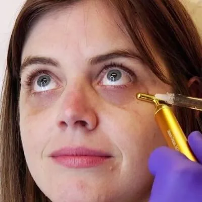 Under Eye Filler for Hollow Eyes and Dark Circles