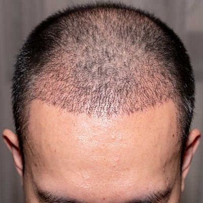 hair regrowth treatment in dubai