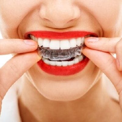 Teeth retainer cost in dubai