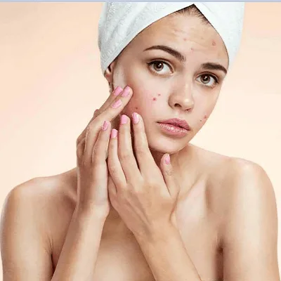 Acne Treatment Options