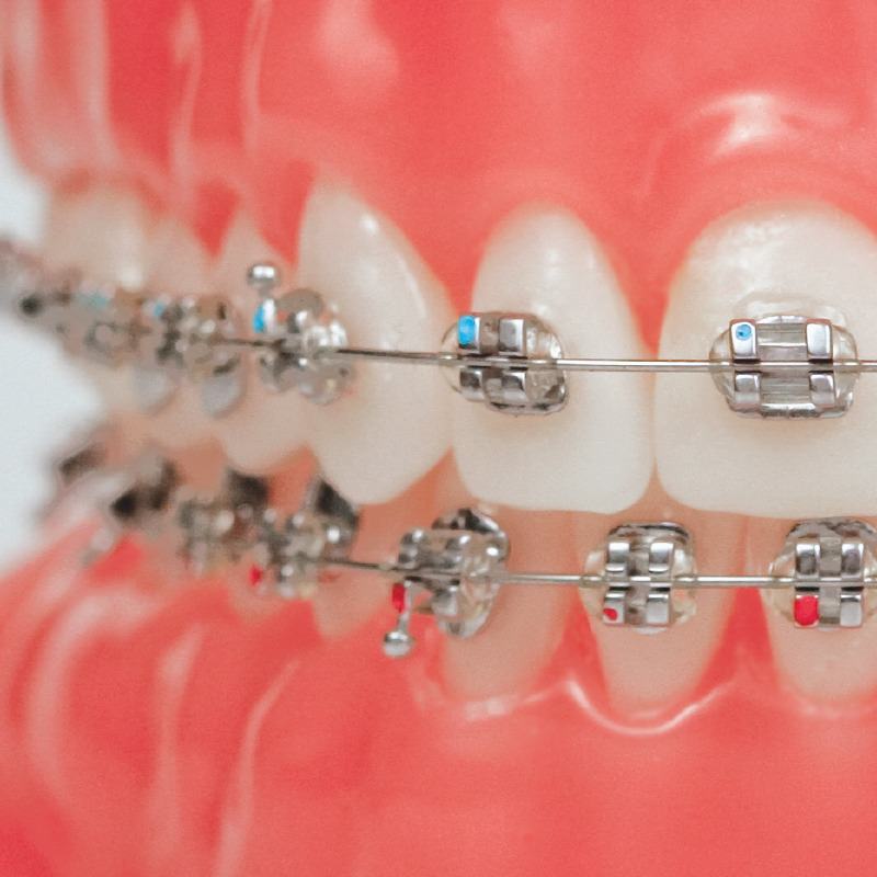 Damon Metal Braces