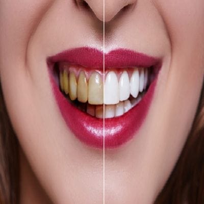 Dental Veneers In Dubai